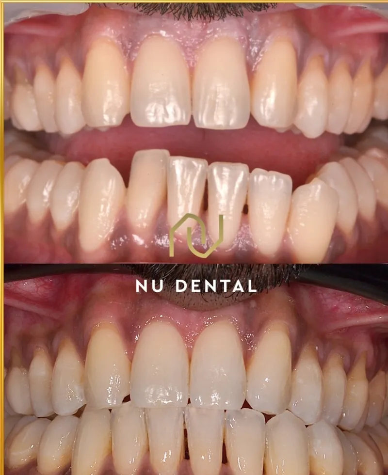 Before-and-after teeth-straightening case 01
