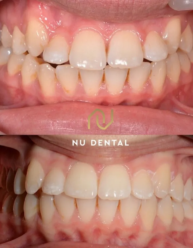 Before-and-after teeth-straightening case 02