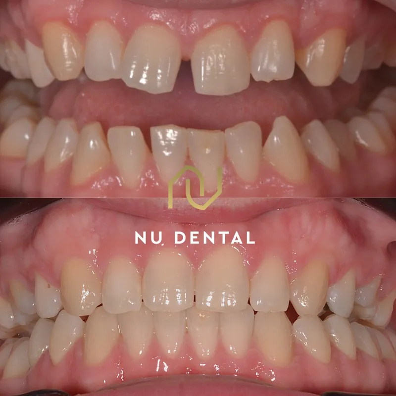 Before-and-after teeth-straightening case 04