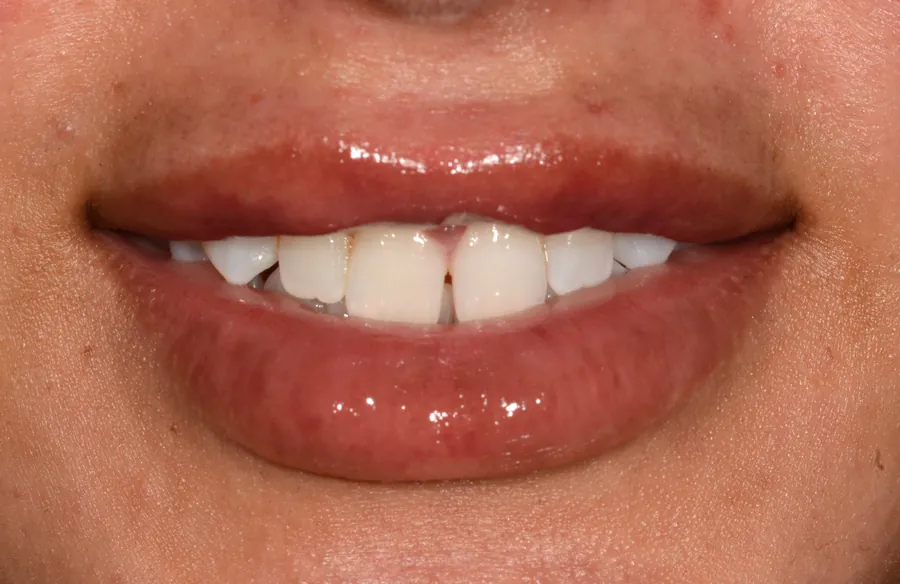 Before clear aligner treatment, case 05