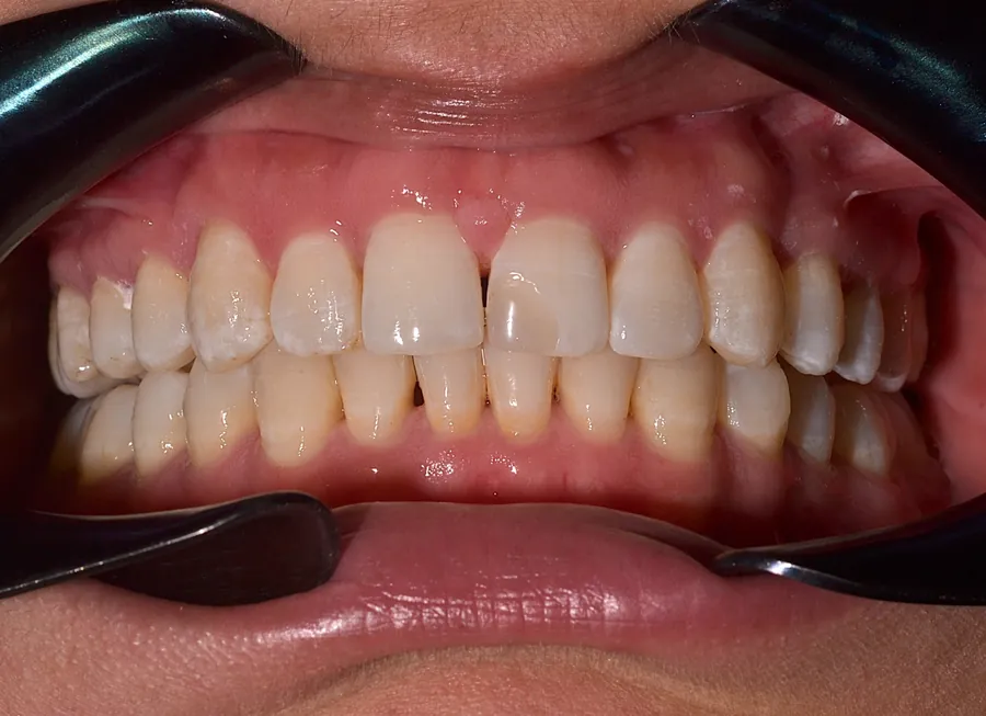After clear aligner treatment, case 06