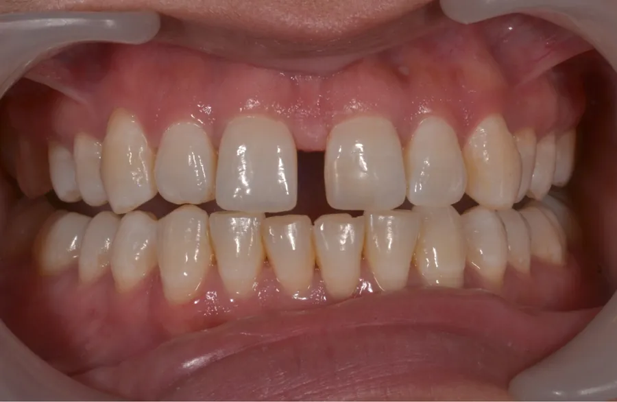 Before clear aligner treatment, case 06
